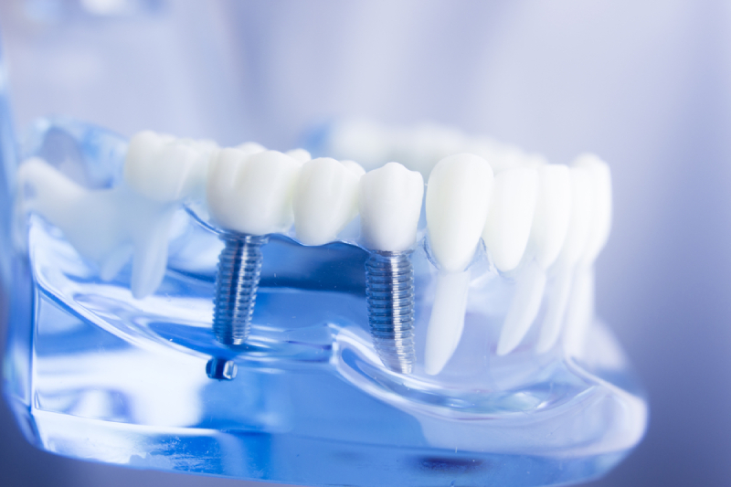 Quality Dental Treatments in Gulf Shores