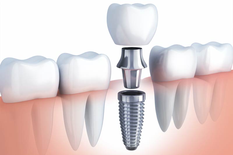 Implants Dentist in Gulf Shores