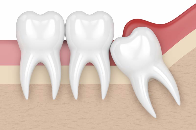 Wisdom Tooth Removal in Gulf Shores